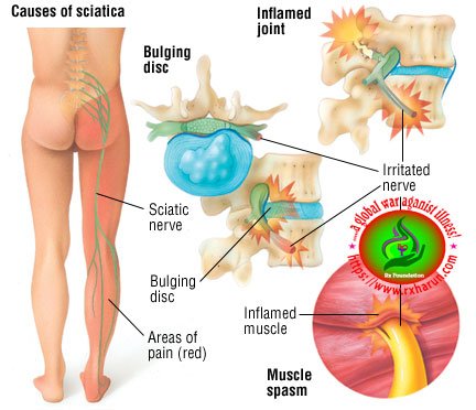 osteoarthritis of spine-bones