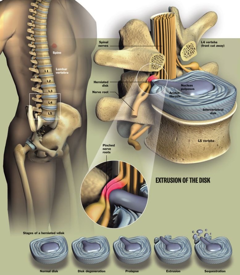 Causes, Symptoms of Lumbar Disc Herniation