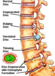 Spine Osteoarthritis