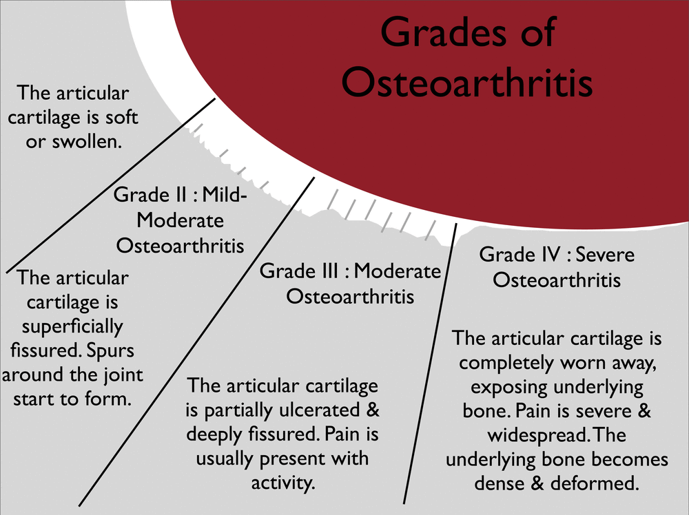osteoarthritis of knee -diagnosis/Grade+of+Osteoathritis
