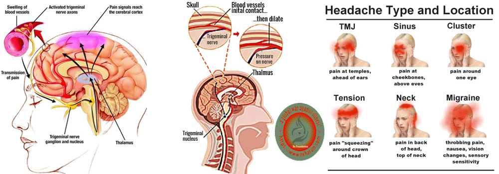 rxharun.com/types-of-headaches/Headache Headache
