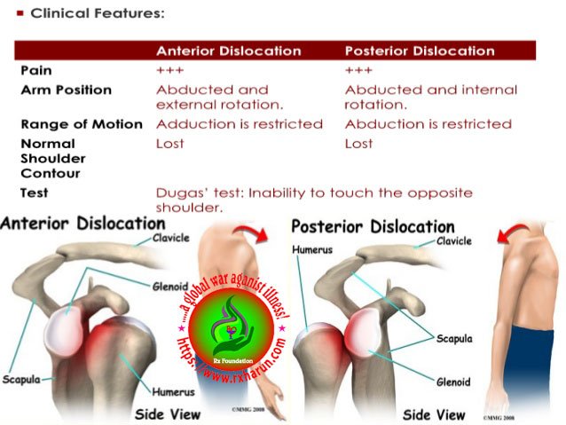 Anterior Dislocation2