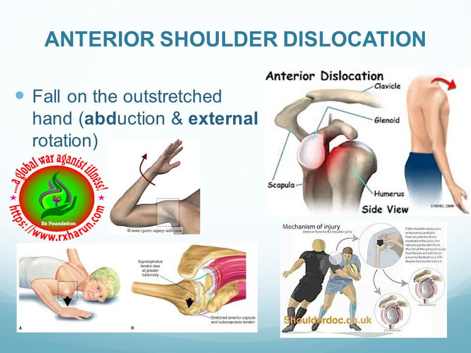 Anterior Dislocation