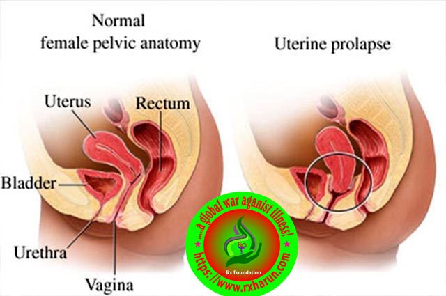 What is the Best Exercise for Uterine Prolapse