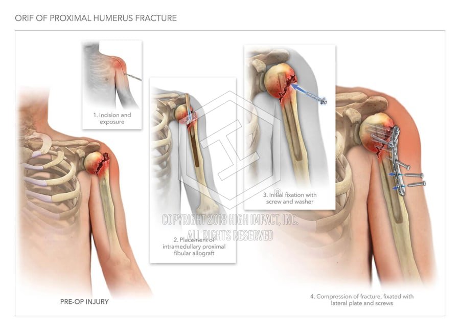 Proximal humeral fractures