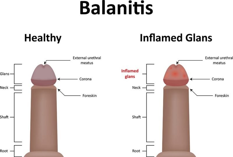 Balanitis