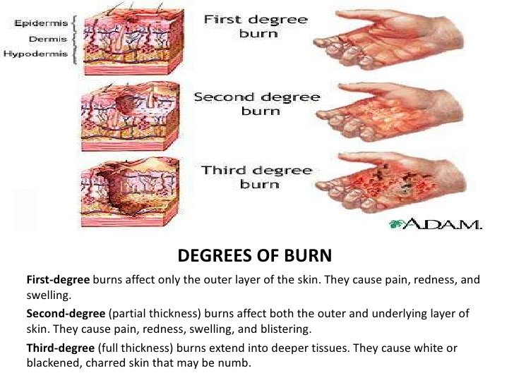 First Aid of Burns