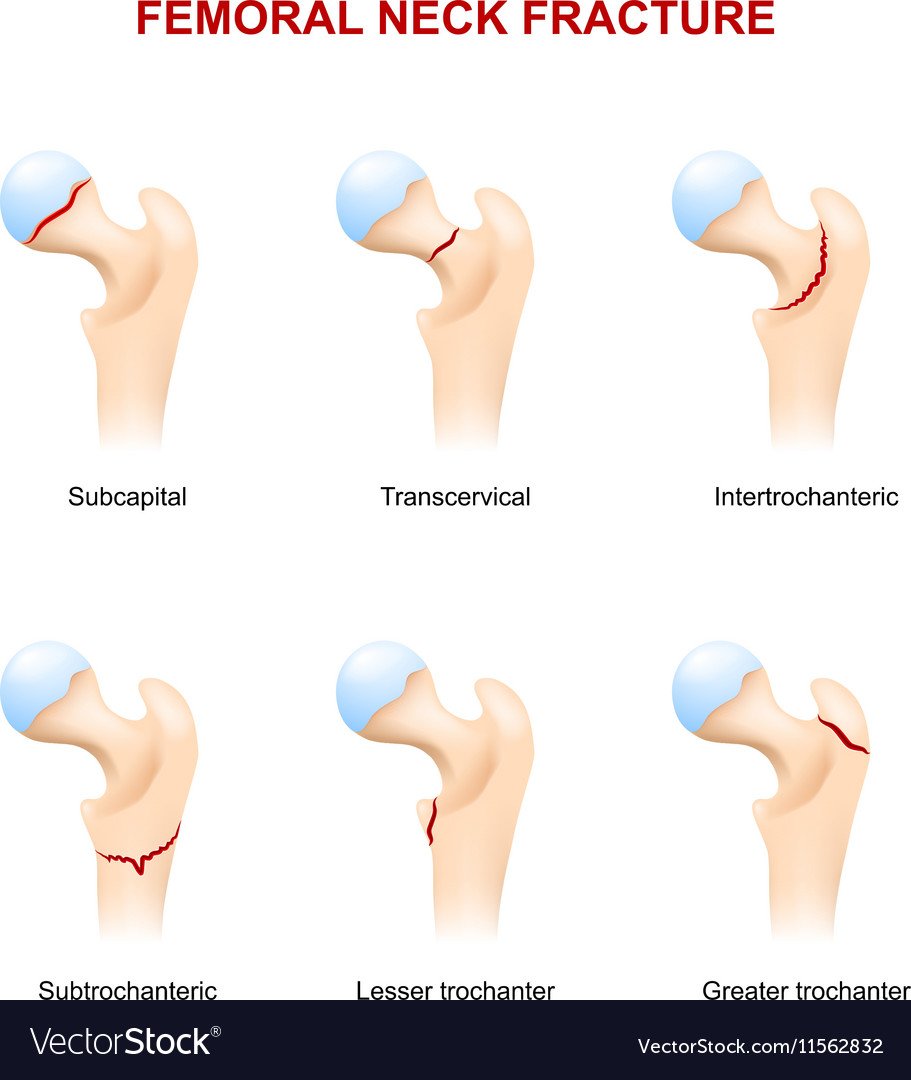 Subcapital Femoral Neck Fractures Diagnosis Treatment