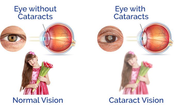 Cortical cataracts