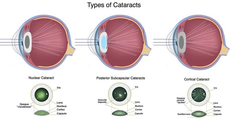 Posterior Subcapsular Cataracts