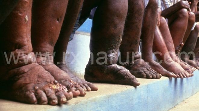 What is Lymphatic Filariasis