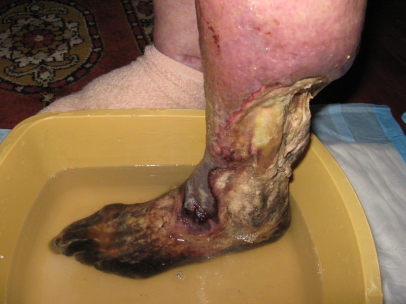 What Is The Best Treatment of Dry Gangrene