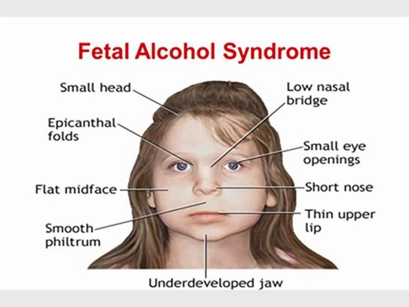 Alcohol symptoms syndrome fetal of Fetal Alcohol