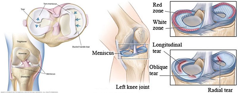 Lateral Meniscus Injury