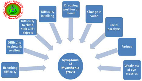 Myasthenia Gravis - Causes, Symptoms, Diagnosis, Treatment