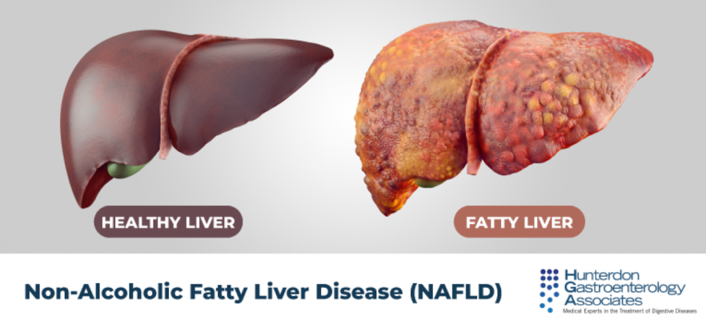 Fatty Liver