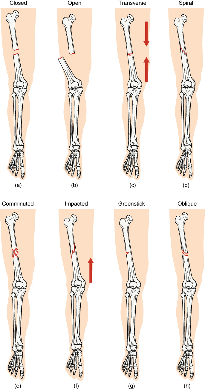 Types of Bone Fractures