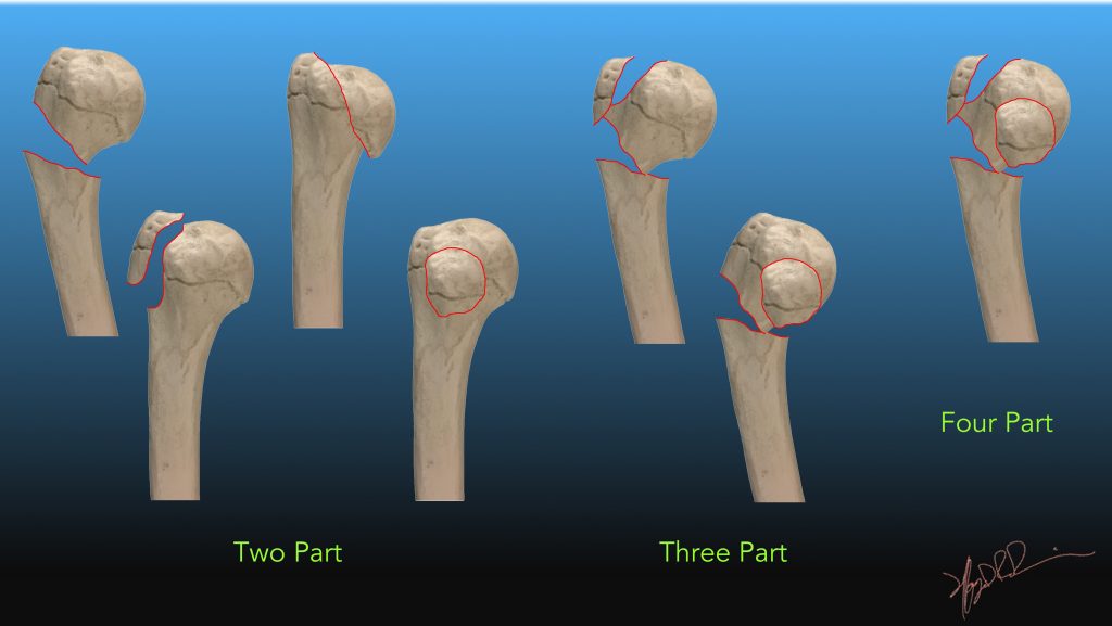 Proximal Humeral Fractures - Causes, Diagnosis, Treatment Proximal Humeral Fractures - Causes, Diagnosis, Treatment