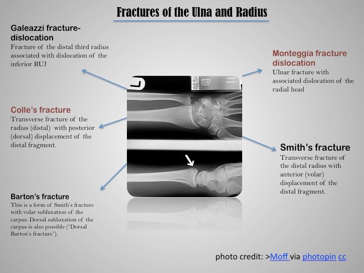 Olecranon Fracture