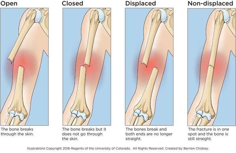 Proximal Forearm Fractures