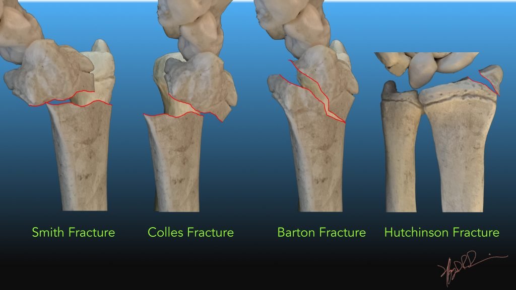 colles fracture broken wrist