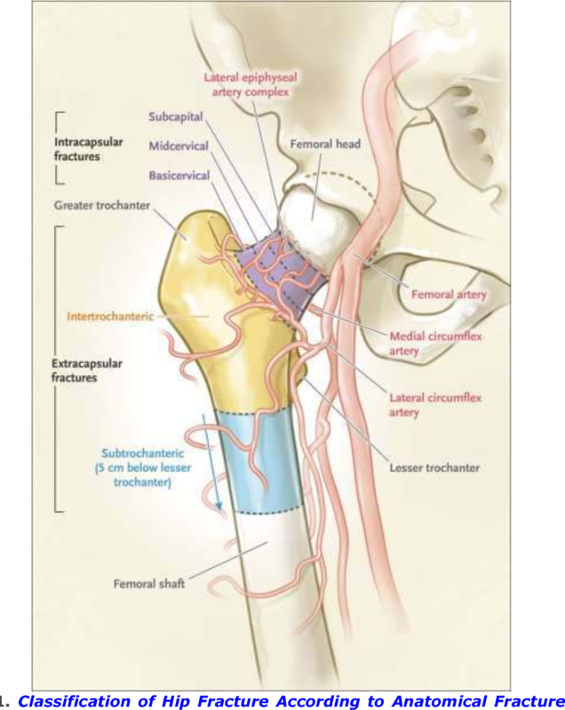 Femoral Shaft Oblique Fractures