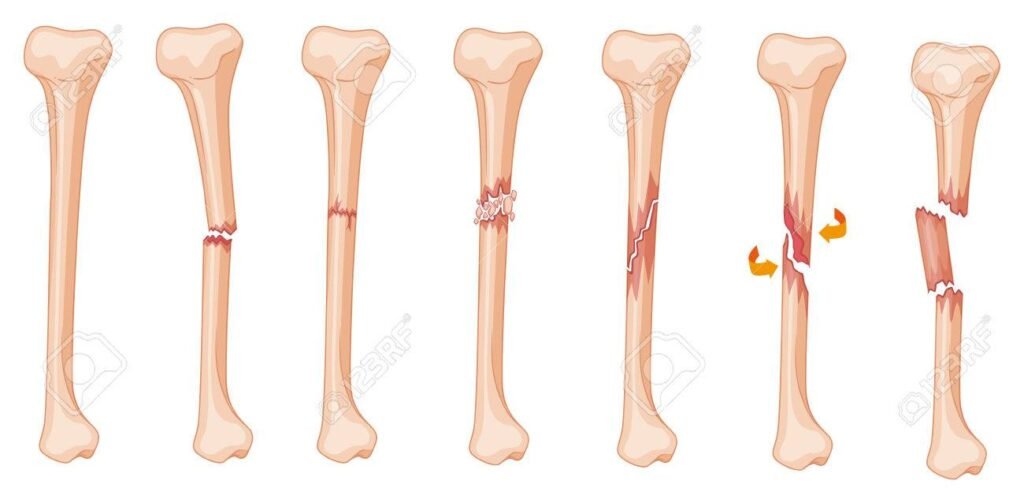 Femoral Shaft Transverse Fractures