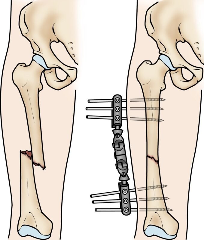 Femoral Shaft Comminuted Fractures