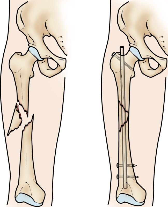 Femoral Shaft Spiral fractures