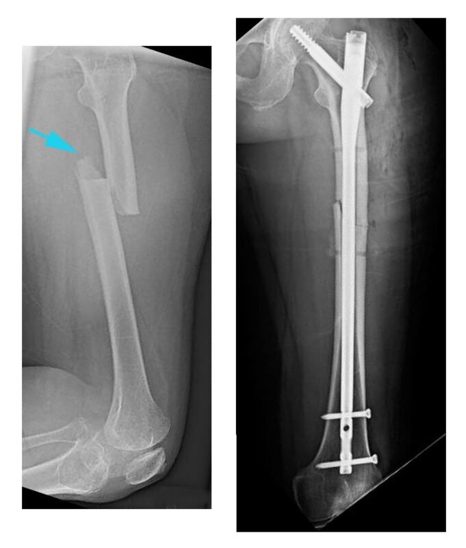 Femoral Shaft Open Fractures