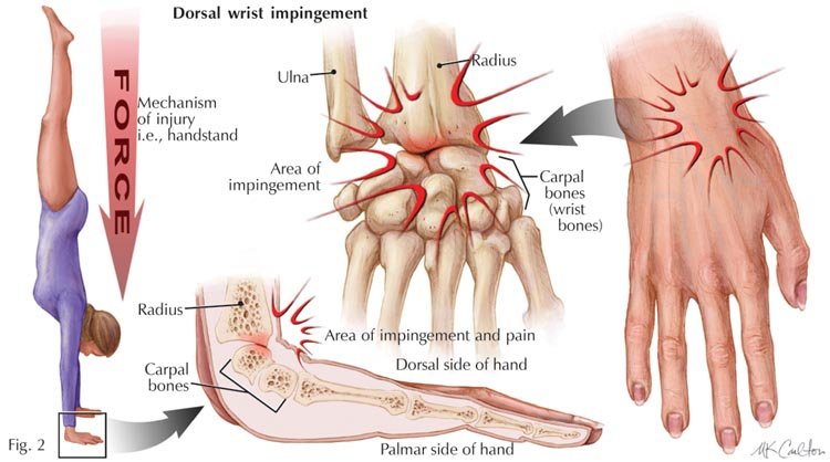 Distal radius fractures