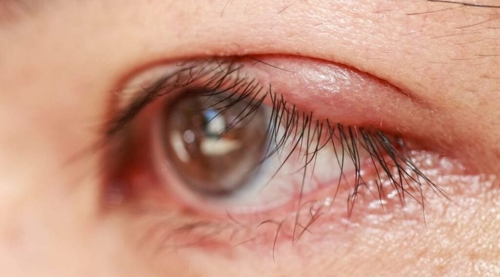 Chalazion Symptoms