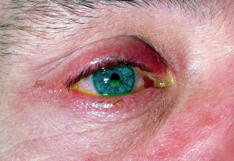 Corneal abrasions