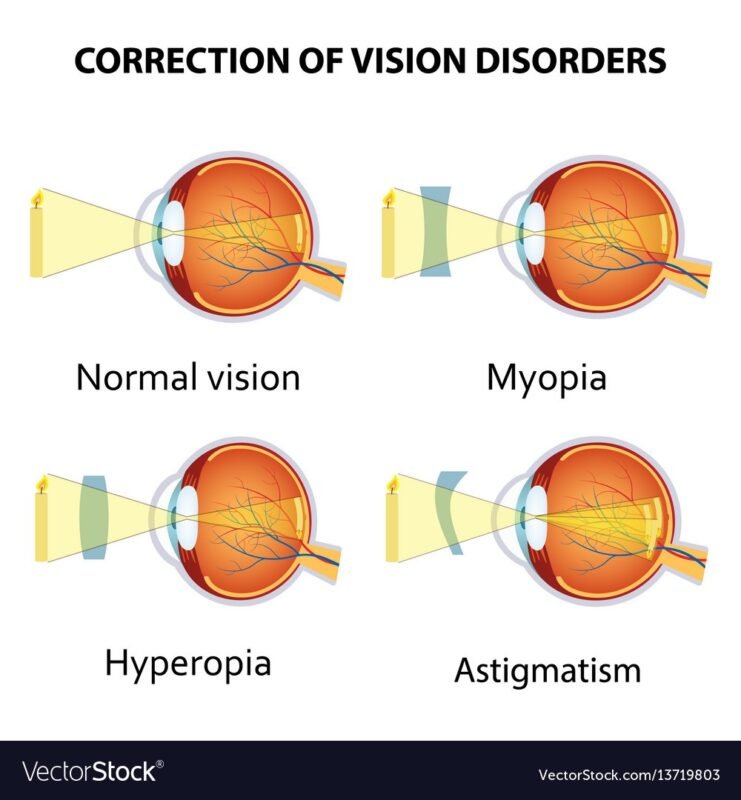 Types of Corneal Transplantation