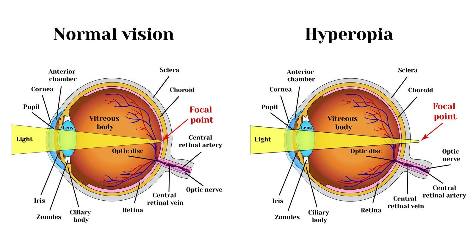 hyperopia-causes-symptoms-treatment-rxharun