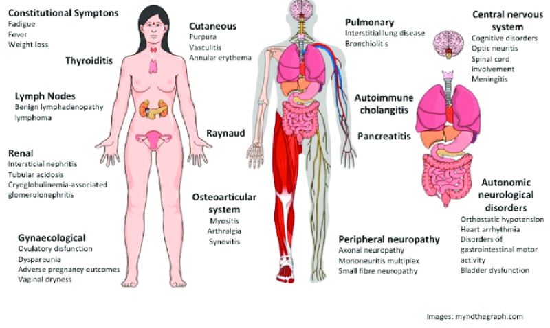 Sjogren’s Syndrome Symptoms