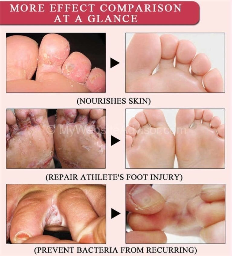 Tinea Pedis Diagnosis Treatment Prevention Rxharun