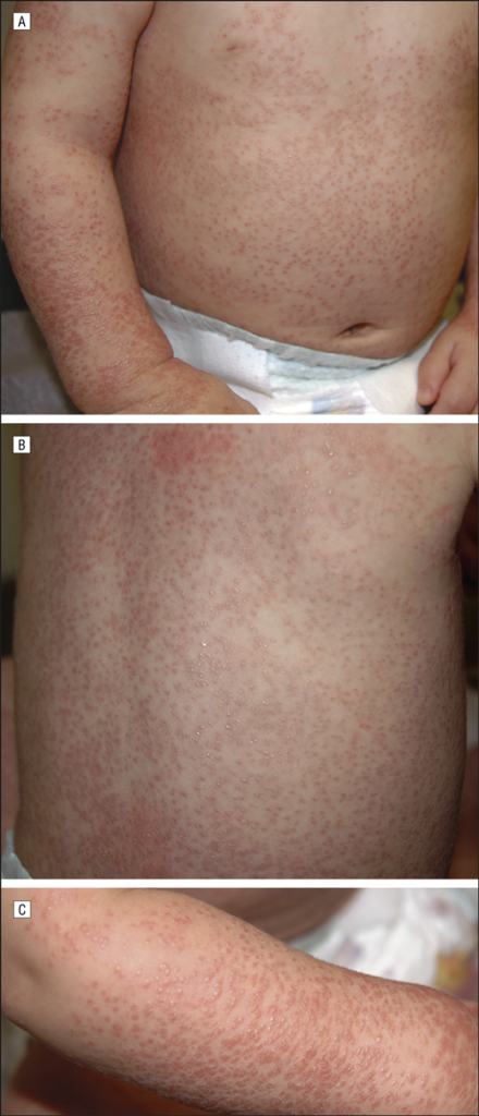 Arthrocutaneouveal granulomatosis