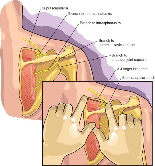 Rotator Cuff Tendinitis