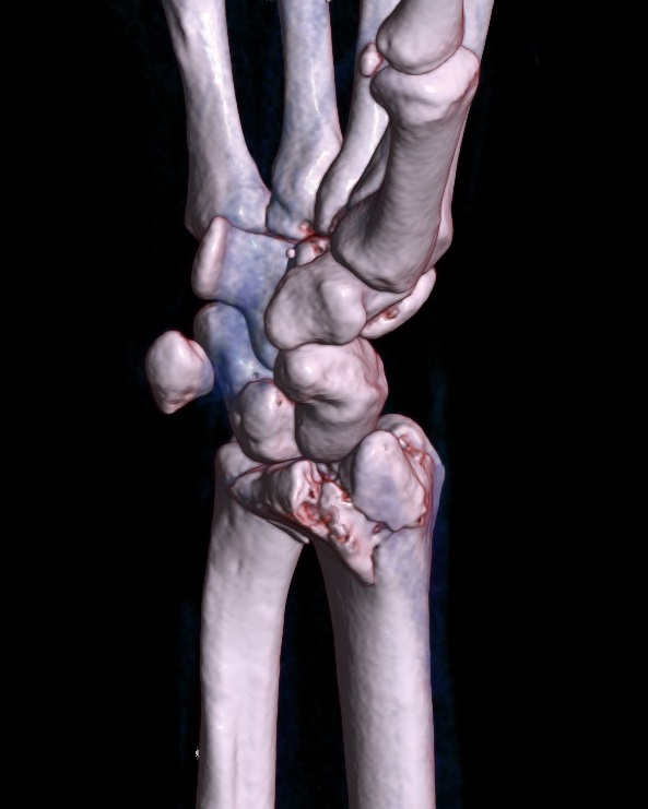 Shoulder and Upper Limb Muscle Attachment A to Z