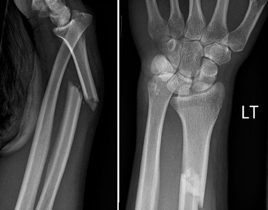 Athlete Forearm Fractures