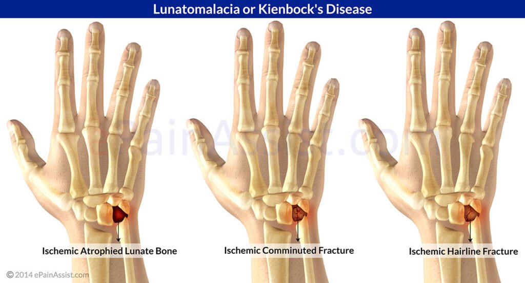 Avascular Necrosis of the Lunate