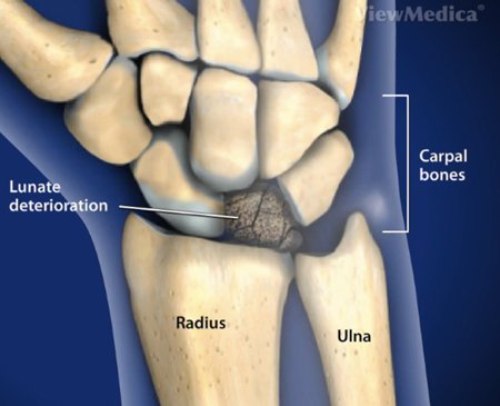 Chauffeur's Fracture