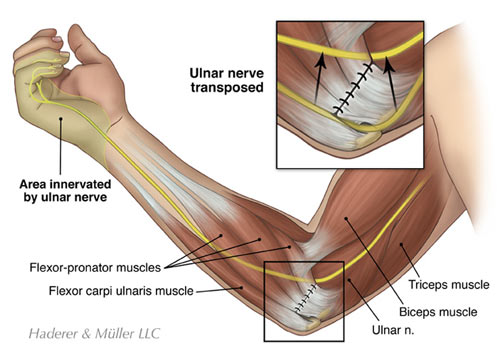 Die-Punch Fracture