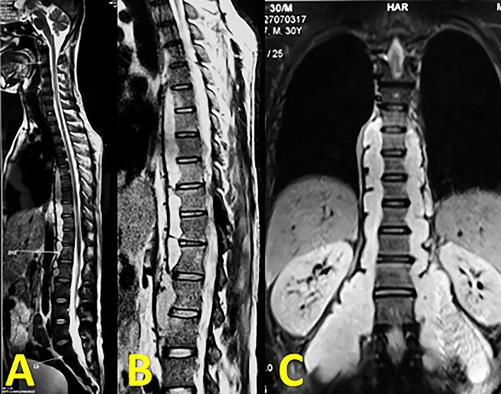 Spinal TB