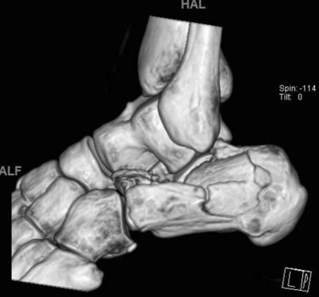 Calcaneus Fractures