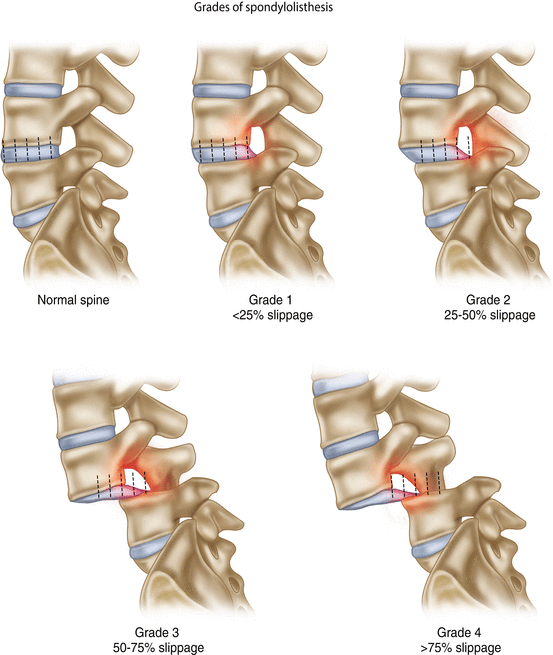 Traumatic Lumbar Locked Facet Syndrome