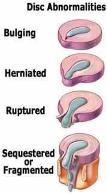 L1 and L2 Disc Herniation