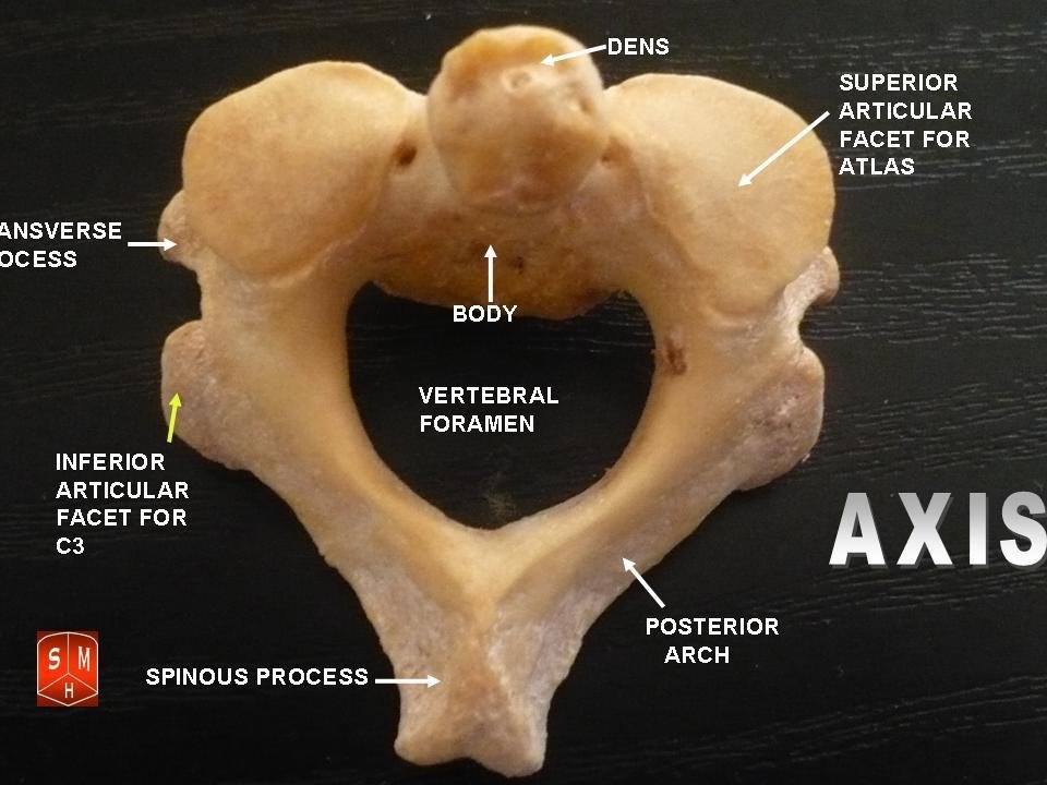 C2 C3 Vertebrae Fracture