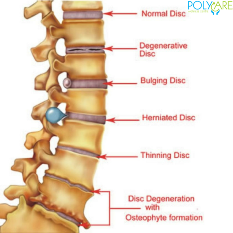 L3 and L4 Disc Herniation